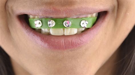 false braces for teeth.